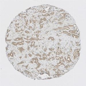 Click to enlarge image Tissue Micro-Array (TMA) core of prostate cancer showing cytoplasmic and membranous staining using Antibody CPTC-STAT3-2. Titer: 1:100