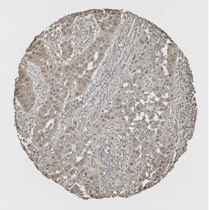 Click to enlarge image Tissue Micro-Array (TMA) core of lung cancer showing cytoplasmic and nuclear staining using Antibody CPTC-ICOSLG-1. Titer: 1:9000
