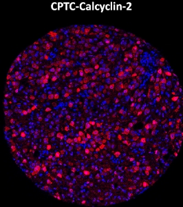 Click to enlarge image Imaging mass cytometry on breast cancer tissue core using CPTC-Calcyclin-2  metal-labeled antibody.  Data shows overlay of target protein signal (red) and DNA (blue). Dilution: 1:100 of 0.5mg/mL stock. Signal was also obtained in other normal tissues (Bone Marrow,  Spleen,  Placenta, Prostate, Colon, Pancreas, Breast, Lung, Testis, Endometrium, Appendix, Kidney) and cancer tissues (Colon, Ovarian, Lung, Prostate).