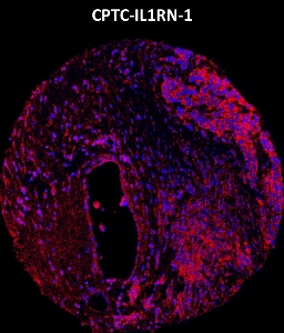 Click to enlarge image Imaging mass cytometry on breast cancer tissue core using CPTC-IL1RN-1 metal-labeled antibody.  Data shows overlay of target protein signal (red) and DNA (blue). Dilution: 1:100 of 0.5mg/mL stock. Signal was also obtained in other normal tissues (testis, prostate, liver, colon, endometrium, appendix, pancreas, bone marrow, breast, kidney, lung, and placenta) and cancer tissues (breast, colon, prostate, lung, and ovarian).