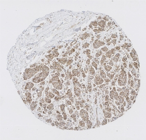 Click to enlarge image Tissue Micro-Array (TMA) core of breast cancer showing cytoplasmic and membranous staining using Antibody CPTC-SIGLEC9-1. Titer: 1:1000