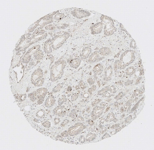 Click to enlarge image Tissue Micro-Array (TMA) core of prostate cancer showing cytoplasmic staining using Antibody CPTC-ADA-1. Titer: 1:1250