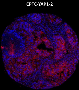 Click to enlarge image Imaging mass cytometry on ovarian cancer tissue core using CPTC-YAP1-2 metal-labeled antibody.  Data shows overlay of target protein signal (red) and DNA (blue). Dilution: 1:100 of 0.5mg/mL stock. Signal was also obtained in other cancer tissues (lung and ovarian).