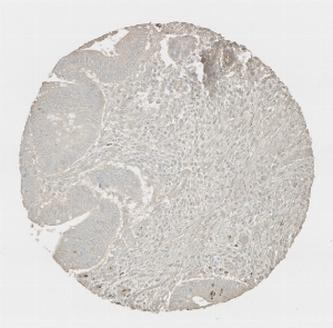 Click to enlarge image Tissue Micro-Array (TMA) core of colon cancer showing cytoplasmic staining using Antibody CPTC-MPO-2 . Titer: 1:1000