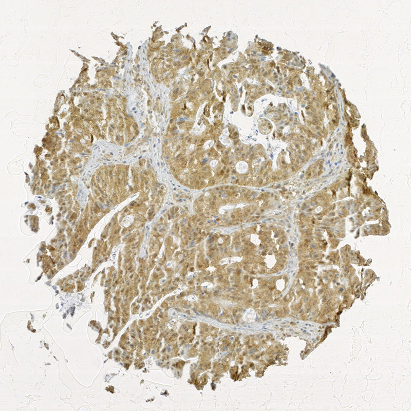 Click to enlarge image Tissue Micro-Array(TMA) core of colon cancer showing cytoplasmic staining using Antibody CPTC-OTUB1-2. Titer: 1:30000