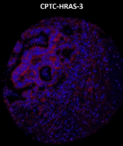 Click to enlarge image Imaging mass cytometry on colon cancer tissue core using CPTC-HRAS-3 metal-labeled antibody.  Data shows an overlay of the target protein signal (red) and DNA (blue). Dilution: 1:100 of 0.5mg/mL stock. Signal was also obtained in other normal tissues (colon, endometrium, appendix, breast, and placenta) and cancer tissues (breast, lung, and ovarian).