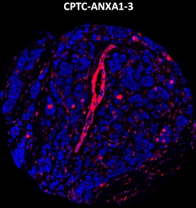 Click to enlarge image Imaging mass cytometry on breast cancer tissue core using CPTC-ANXA1-3 metal-labeled antibody.  Data shows an overlay of the target protein signal (red) and DNA (blue). Dilution: 1:100 of 0.5mg/mL stock. Signal was also obtained in other normal tissues (liver, bone marrow, spleen, prostate, colon, pancreas, breast, lung, testis, endometrium, appendix, and kidney) and cancer tissues (breast, lung, prostate, colon, and ovarian).