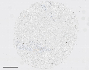 Click to enlarge image Tissue Micro-Array(TMA) core of pancreatic cancer showing cytoplasmic staining using Antibody CPTC-LAT-1. Titer: 1:6250
