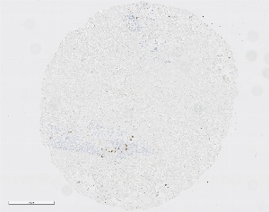 点击放大图像，胰腺癌组织微阵列（TMA）核心显示使用抗体CPTC-LAT-1进行细胞质染色。标题：1:6250