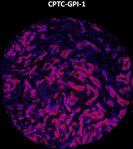 Click to enlarge image Imaging mass cytometry on prostate cancer tissue core using CPTC-GPI-1 metal-labeled antibody.  Data shows an overlay of the target protein signal (red) and DNA (blue). Dilution: 1:100 of 0.5mg/mL stock. Signal was also obtained in other normal tissues (liver, bone marrow, spleen, placenta, prostate, colon, pancreas, breast, lung, testis, endometrium, appendix, and kidney) and cancer tissues (colon, breast, ovarian, lung, and prostate).