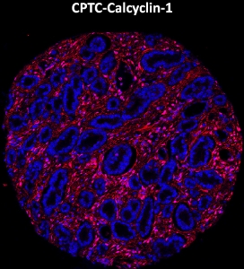Click to enlarge image Imaging mass cytometry on prostate cancer tissue core using CPTC-Calcyclin-1 metal-labeled antibody.  Data shows an overlay of the target protein signal (red) and DNA (blue). Dilution: 1:100 of 0.5mg/mL stock. Signal was also obtained in other normal tissues (bone marrow, spleen, placenta, prostate, colon, pancreas, breast, lung, testis, endometrium, appendix, and kidney) and cancer tissues (breast, colon, ovarian, lung, and prostate).