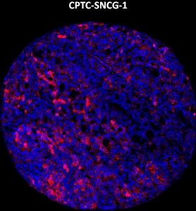 Click to enlarge image Imaging mass cytometry on ovarian cancer tissue core using CPTC-SNCG-1 metal-labeled antibody.  Data shows an overlay of the target protein signal (red) and DNA (blue). Dilution: 1:100 of 0.5mg/mL stock. Signal was also obtained in other normal tissues (colon, pancreas, breast, lung, testis, endometrium, appendix, and kidney) and cancer tissues (breast, colon, ovarian, and lung).