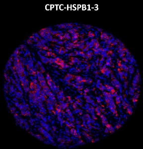 Click to enlarge image Imaging mass cytometry on breast cancer tissue core using CPTC-HSPB1-3 metal-labeled antibody.  Data shows an overlay of the target protein signal (red) and DNA (blue). Dilution: 1:100 of 0.5mg/mL stock. Signal was also obtained in other normal tissues (liver, colon, endometrium, appendix, breast, kidney, lung, and placenta) and cancer tissues (breast, colon, lung, and ovarian).