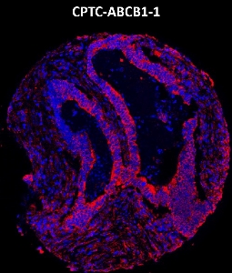 Click to enlarge image Imaging mass cytometry on colon cancer tissue core using CPTC-PCNA-4 metal-labeled antibody.  Data shows an overlay of the target protein signal (red) and DNA (blue). Dilution: 1:100 of 0.5mg/mL stock. Signal was also obtained in other normal tissues (testis, prostate, liver, colon, endometrium, appendix, pancreas, bone marrow, breast, kidney, lung, and placenta) and cancer tissues (breast, lung, prostate, colon and ovarian).