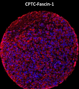 Click to enlarge image Imaging mass cytometry on breast cancer tissue core using CPTC-Fascin1-1 metal-labeled antibody.  Data shows overlay of target protein signal (red) and DNA (blue). Dilution: 1:100 of 0.5mg/mL stock. Signal was also obtained in other normal tissues (testis, prostate, liver, colon, endometrium, appendix, pancreas, bone marrow, breast, kidney, lung, and placenta) and cancer tissue (breast, colon, prostate, lung, and ovarian).
