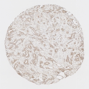 Click to enlarge image Tissue Micro-Array (TMA) core of prostate cancer  showing cytoplasmic and membranous staining using Antibody CPTC-IFIT2-1. Titer: 1:1000