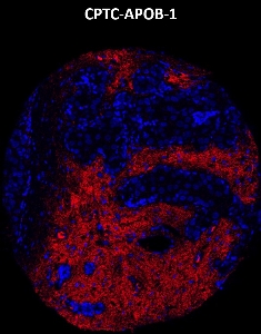 Click to enlarge image Imaging mass cytometry on breast cancer tissue core using CPTC-APOB-1 metal-labeled antibody.  Data shows an overlay of the target protein signal (red) and DNA (blue). Dilution: 1:100 of 0.5mg/mL stock Signal was also obtained in other normal tissues (testis, prostate, liver, colon, endometrium, appendix, pancreas, bone marrow, breast, kidney, lung, and placenta) and cancer tissues (breast, colon, prostate, lung, and ovarian).