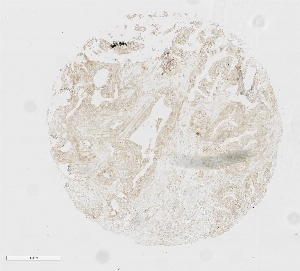 Click to enlarge image Tissue Micro-Array(TMA) core of pancreatic cancer showing cell membrane staining using Antibody CPTC-PAK4-1. Titer: 1:50