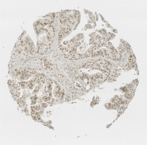 Click to enlarge image Tissue Micro-Array (TMA) core of colon cancer showing nuclear staining using Antibody CPTC-MSH2-1. Titer: 1:50