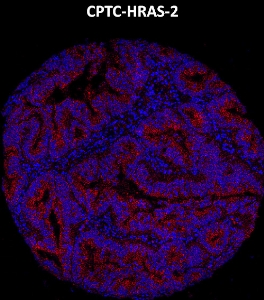 Click to enlarge image Imaging mass cytometry on colon cancer tissue core using CPTC-HRAS-2 metal-labeled antibody.  Data shows overlay of target protein signal (red) and DNA (blue). Dilution: 1:100 of 0.5mg/mL stock. Signal was also obtained in other normal tissues (testis, colon, and kidney) and cancer tissues (colon and ovarian).