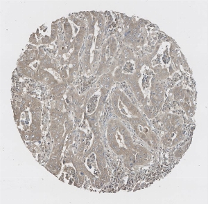 Click to enlarge image Tissue Micro-Array(TMA) core of lung cancer  showing cytoplasmic staining using Antibody CPTC-CD274-1. Titer: 1:1000