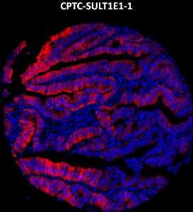 Click to enlarge image Imaging mass cytometry on colon cancer tissue core using CPTC-SULT1E1-1 metal-labeled antibody.  Data shows an overlay of the target protein signal (red) and DNA (blue). Dilution: 1:100 of 0.5mg/mL stock. Signal was also obtained in other normal tissues (liver, prostate, colon, pancreas, breast, lung, testis, endometrium, appendix, and kidney) and cancer tissues (breast and colon).