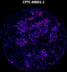 Click to enlarge image Imaging mass cytometry on ovarian cancer tissue core using CPTC-MBD1-1 metal-labeled antibody.  Data shows an overlay of the target protein signal (red) and DNA (blue). Dilution: 1:100 of 0.5mg/mL stock. Signal was also obtained in other normal tissues (liver, placenta, prostate, pancreas, breast, lung, endometrium, appendix, and spleen) and cancer tissues (breast, prostate, colon, ovarian, and lung).