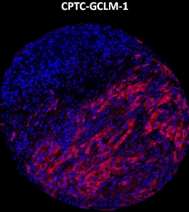 Click to enlarge image Imaging mass cytometry on lung cancer tissue core using CPTC-GCLM-1 metal-labeled antibody.  Data shows an overlay of the target protein signal (red) and DNA (blue). Dilution: 1:100 of 0.5mg/mL stock. Signal was also obtained in other normal tissues (prostate, colon, pancreas, breast, lung, testis, endometrium, appendix, and kidney) and cancer tissues (colon, breast, ovarian, lung, and prostate).