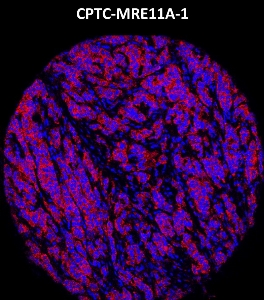 Click to enlarge image Imaging mass cytometry on lung cancer tissue core using CPTC-MRE11A-1 metal-labeled antibody.  Data shows overlay of target protein signal (red) and DNA (blue). Dilution: 1:100 of 0.5mg/mL stock. Signal was also obtained in other normal tissues (prostate, liver, colon, endometrium, pancreas, bone marrow, breast, and kidney) and cancer tissues (breast, colon, prostate, lung, and ovarian).