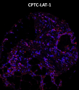 Click to enlarge image Imaging mass cytometry on breast cancer tissue core using CPTC-LAT-1 metal-labeled antibody.  Data shows overlay of target protein signal (red) and DNA (blue). Dilution: 1:100 of 0.5mg/mL stock. Signal was also obtained in other normal tissues (colon, pancreas, bone marrow, breast, and kidney) and cancer tissues (breast, colon, lung, and ovarian).