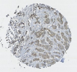 Click to enlarge image Tissue Microarray cor of breast cancer showing immunohistochemical staining for CPTC-CDH1-4.