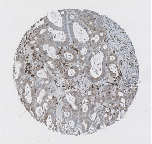 Click to enlarge image Tissue Micro-Array (TMA) core of colon cancer  showing cytoplasmic and membranous staining using Antibody CPTC-CD74-1. Titer: 1:50