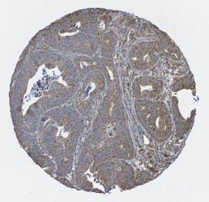 Click to enlarge image Tissue Microarray core of colon cancer showing immunochistochemical staining for CPTC-BRAF-5.