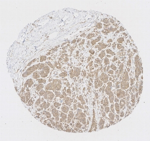 Click to enlarge image Tissue Micro-Array (TMA) core of breast  showing cytoplasmic staining using Antibody CPTC-CRABP2-1. Titer: 1:1000