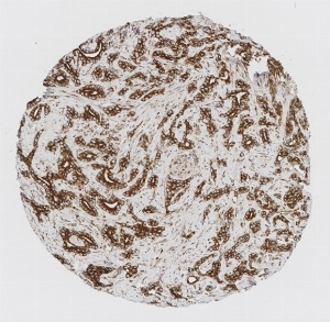 Click to enlarge image Tissue Micro-Array (TMA) core of prostate cancer showing cytoplasmic and membranous staining using Antibody CPTC-ITGA11-1. Titer: 1:1000