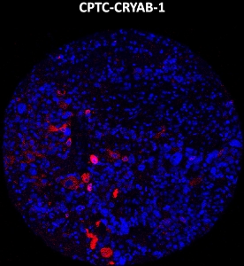 Click to enlarge image Imaging mass cytometry on ovarian cancer tissue core using CPTC-CRYAB-1 metal-labeled antibody.  Data shows an overlay of the target protein signal (red) and DNA (blue). Dilution: 1:100 of 0.5mg/mL stock. Signal was also obtained in other normal tissues (appendix and kidney) and cancer tissue (ovarian).