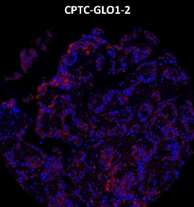 Click to enlarge image Imaging mass cytometry on ovarian cancer tissue core using CPTC-GLO1-2 metal-labeled antibody.  Data shows overlay of target protein signal (red) and DNA (blue). Dilution: 1:100 of 0.5mg/mL stock. Signal was also obtained in other normal tissues (endometrium, pancreas, bone marrow, breast, and kidney) and cancer tissues (breast, colon, lung, and ovarian).