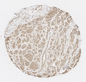 Click to enlarge image Tissue Micro-Array (TMA) core of breast cancer  showing cytoplasmic staining using Antibody CPTC- CPTC-PRDX4-5. Titer: 1:20000