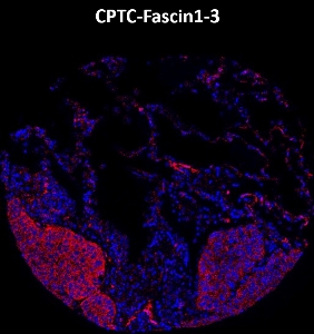 Click to enlarge image Imaging mass cytometry on lung cancer tissue core using CPTC-Fascin1-3 metal-labeled antibody.  Data shows an overlay of the target protein signal (red) and DNA (blue). Dilution: 1:100 of 0.5mg/mL stock. Signal was also obtained in other normal tissues (testis, liver, colon, endometrium, appendix, breast, kidney, lung, and placenta) and cancer tissues (breast, colon, prostate, lung, and ovarian).