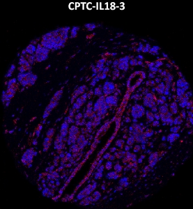 Click to enlarge image Imaging mass cytometry on breast cancer tissue core using CPTC-IL18-3 metal-labeled antibody.  Data shows an overlay of the target protein signal (red) and DNA (blue). Dilution: 1:100 of 0.5mg/mL stock. Signal was also obtained in other normal tissues (liver, bone marrow, spleen, placenta, prostate, pancreas, breast, lung, testis, endometrium, and appendix) and cancer tissues (breast, ovarian, lung, and prostate).