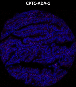 Click to enlarge image Imaging mass cytometry on colon cancer tissue core using CPTC-PVR-1 metal-labeled antibody.  Data shows overlay of target protein signal (red) and DNA (blue). Dilution: 1:100 of 0.5mg/mL stock. Signal was also obtained in other normal tissue (spleen) and cancer tissues (colon and prostate).