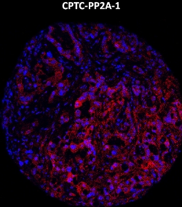 Click to enlarge image Imaging mass cytometry on lung cancer tissue core using CPTC-PP2A-1 metal-labeled antibody.  Data shows an overlay of the target protein signal (red) and DNA (blue). Dilution: 1:100 of 0.5mg/mL stock. Signal was also obtained in other normal tissues (breast and endometrium) and cancer tissues (breast, colon, ovarian, lung, and prostate).