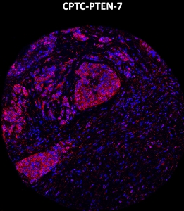 Click to enlarge image Imaging mass cytometry on breast cancer tissue core using CPTC-PTEN-7 metal-labeled antibody.  Data shows an overlay of the target protein signal (red) and DNA (blue). Dilution: 1:100 of 0.5mg/mL stock. Signal was also obtained in other normal tissues (prostate, colon, pancreas, breast, lung, testis, endometrium, and kidney) and cancer tissues (breast, colon, ovarian, and lung).