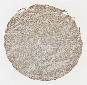 Click to enlarge image Tissue Microarray core immunohistochemically stained with antibody CPTC-PTEN-6