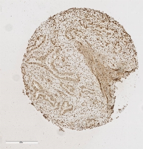 Click to enlarge image Tissue Micro-Array(TMA) core of pancreatic cancer showing nuclear staining using Antibody CPTC-TP53BP1-1. Titer: 1:1250