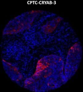Click to enlarge image Imaging mass cytometry on lung cancer tissue core using CPTC-CRYAB-3 metal-labeled antibody.  Data shows an overlay of the target protein signal (red) and DNA (blue). Dilution: 1:100 of 0.5mg/mL stock. Signal was also obtained in other normal tissues (colon, pancreas, breast, lung, appendix, and kidney) and cancer tissues (ovarian and lung).