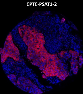 Click to enlarge image Imaging mass cytometry on ovarian cancer tissue core using CPTC-PSAT1-2 metal-labeled antibody.  Data shows an overlay of the target protein signal (red) and DNA (blue). Dilution: 1:100 of 0.5mg/mL stock. Signal was also obtained in other normal tissues (testis, liver, endometrium, appendix, pancreas, bone marrow, breast, and kidney) and cancer tissues (breast, colon, prostate, lung, and ovarian).