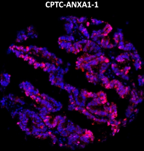 Click to enlarge image Imaging mass cytometry on ovarian cancer tissue core using CPTC-ANXA1-1 metal-labeled antibody.  Data shows an overlay of the target protein signal (red) and DNA (blue). Dilution: 1:100 of 0.5mg/mL stock. Signal was also obtained in other normal tissues (liver, bone marrow, endometrium, testis, prostate, and lung) and cancer tissues (breast, lung, prostate, colon and ovarian).