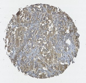 Click to enlarge image Tissue Microarray core of lung cancer immunohistochemically stained with antibody CPTC-FOS-1