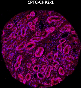 Click to enlarge image Imaging mass cytometry on prostate cancer tissue core using CPTC-CHP2-1 metal-labeled antibody.  Data shows an overlay of the target protein signal (red) and DNA (blue). Dilution: 1:100 of 0.5mg/mL stock. Signal was also obtained in other normal tissues (prostate, colon, pancreas, breast, lung, testis, endometrium, appendix, and kidney) and cancer tissues (breast, colon, ovarian, lung, and prostate).